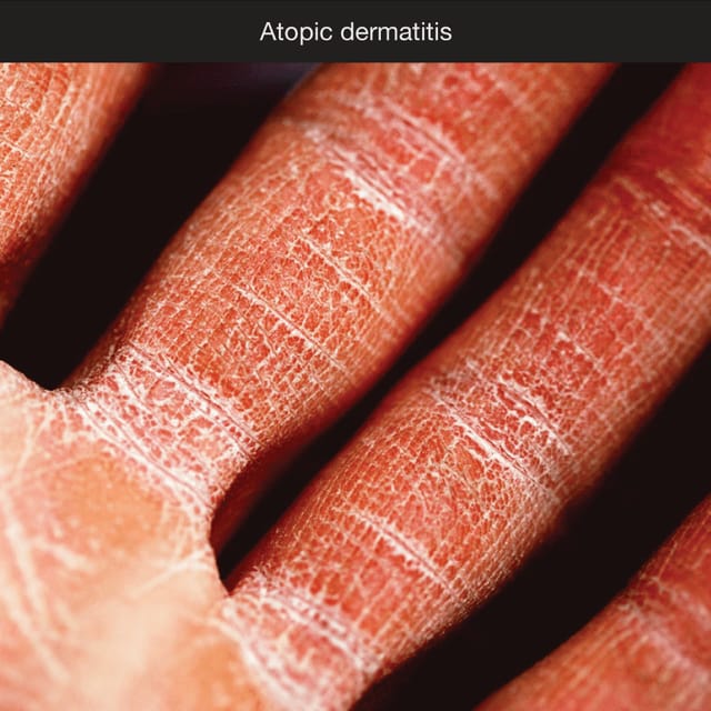 Close-up of a hand with atopic dermatitis, the skin dry and cracked
